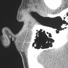 Axial CT scan picture shows an ovoid cyst medial to the concha and protruding slightly into the post-auricular sulcus.[2]