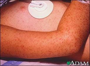 Rocky Mountain spotted fever is a potentially fatal infection transmitted to humans by ticks. This photograph shows the classical appearing rash which often begins on the wrists and ankles, and spreads rapidly towards the center of the body. The rash may also be present on the palms and soles