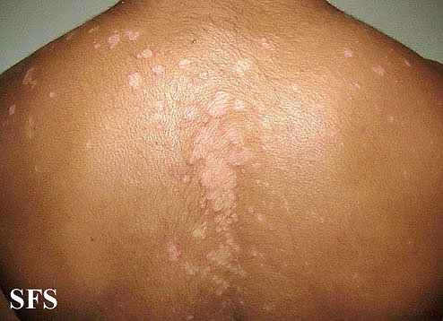 File:Seborrhoeic dermatitis 12.jpeg