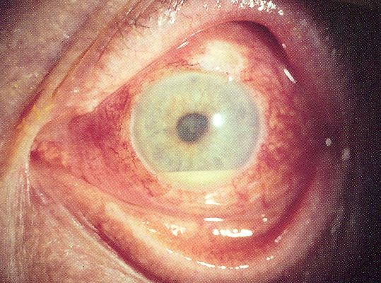 Uveitis with pus in the anterior chamber