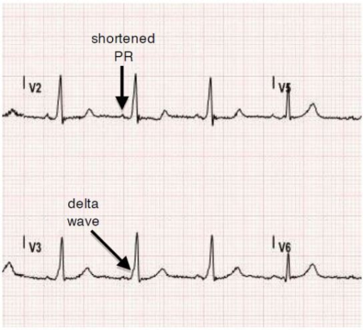 File:WPW Syndrome - ECG changes with delta wave.png