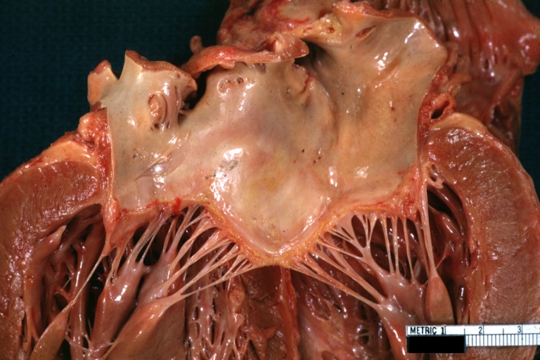 Rheumatic mitral valvulitis: Gross, an example of acute rheumatic fever lesion along line of closure of mitral valve