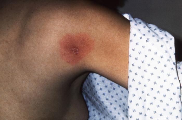 Posterior right shoulder region of a patient who’d presented with the erythema migrans (EM) rash characteristic of what was diagnosed as Lyme disease, caused by Borrelia burgdorferi. From Public Health Image Library (PHIL). [3]