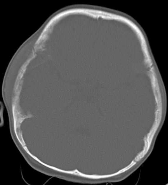 Neuroblastoma observed on head CT scan as lytic deposit noted in the right fronto-parietal skull due to metastatic spread<ref name="radio">