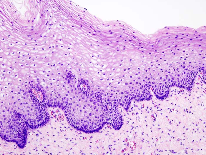 File:Cervical intraepithelial neoplasia (1) normal squamous epithelium.jpg