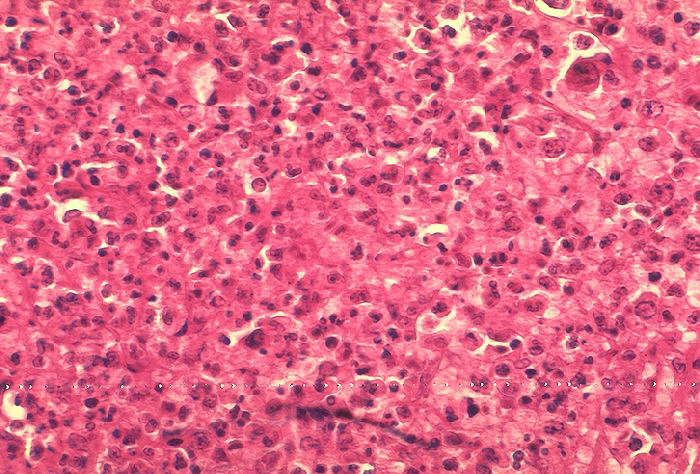 "Histopathology of mediastinal lymph node in fatal human anthrax” Adapted from Public Health Image Library (PHIL), Centers for Disease Control and Prevention.[20]
