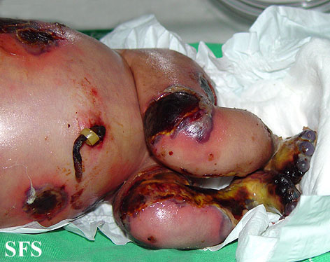 File:Epidermolysis bullosa&pseudomonas Infection07.jpg