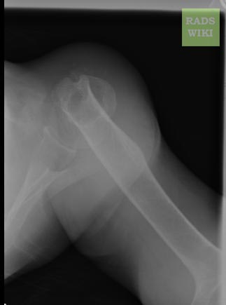 File:Humeral-neck-fracture-004.jpg
