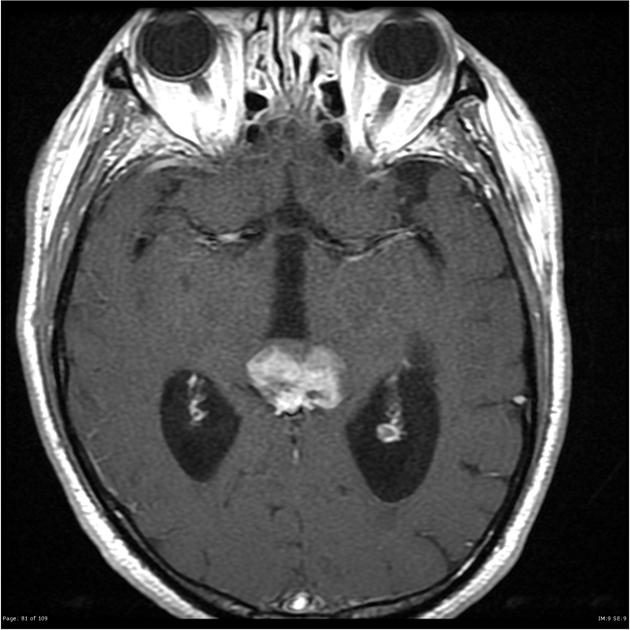 Axial T1 with contrast demonstrating an irregular heterogenous enhancing pineal mass with several tiny cystic foci and eccentric coarse calcifications. There is moderate mass effect on the adjacent tectum and vermis, with loss of definition and possible parenchymal invasion on the left. There is associated aqueduct compression with moderate hydrocephalus.[24]