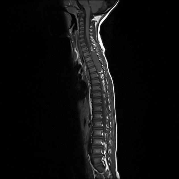 Neuroblastoma observed on sagittal MRI as a large mass which extends into the spinal canal and causes significant cord compression[4]