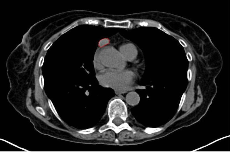CT shows Thymoma (Thymoma, Stage IIA. CT scan, axial)
