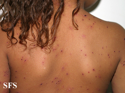 Varicella From Public Health Image Library (PHIL). [2]