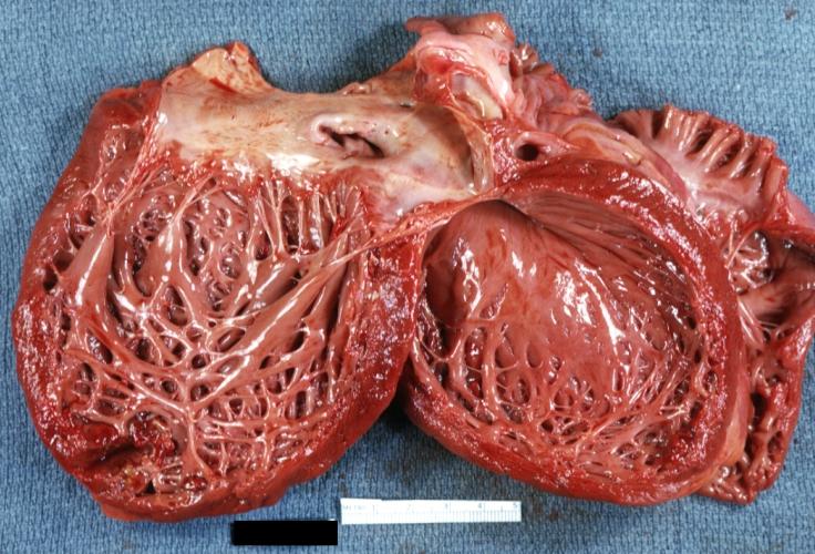 Dilated Cardiomyopathy: Gross opened globular left ventricle natural color (very good example)