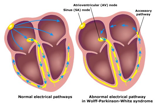 The normal conduction of electrical signals in heart versus that in the presence of an accessory pathway