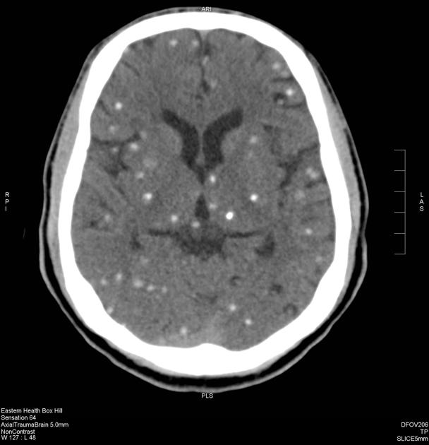 Several calcified nodules are seen in the brain parenchyma