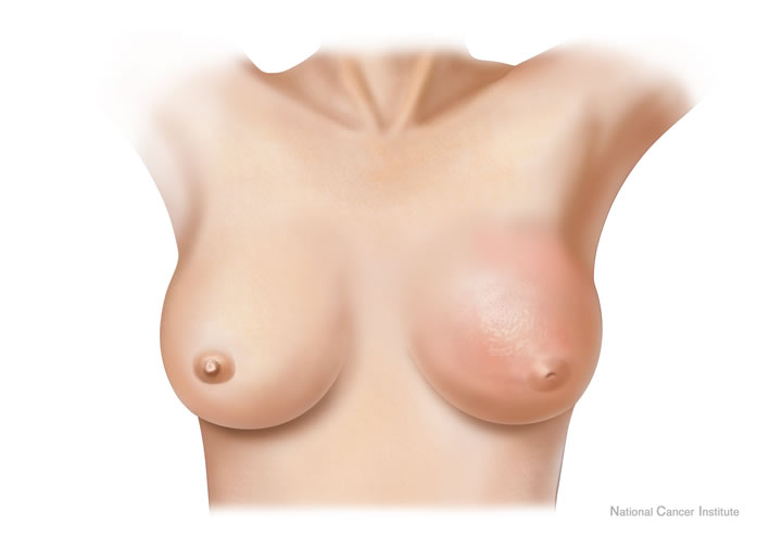 Drawing of inflammatory breast cancer