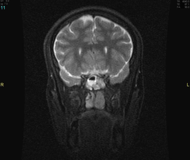 File:MRI T2 esthesioneuroblastoma 1.jpg