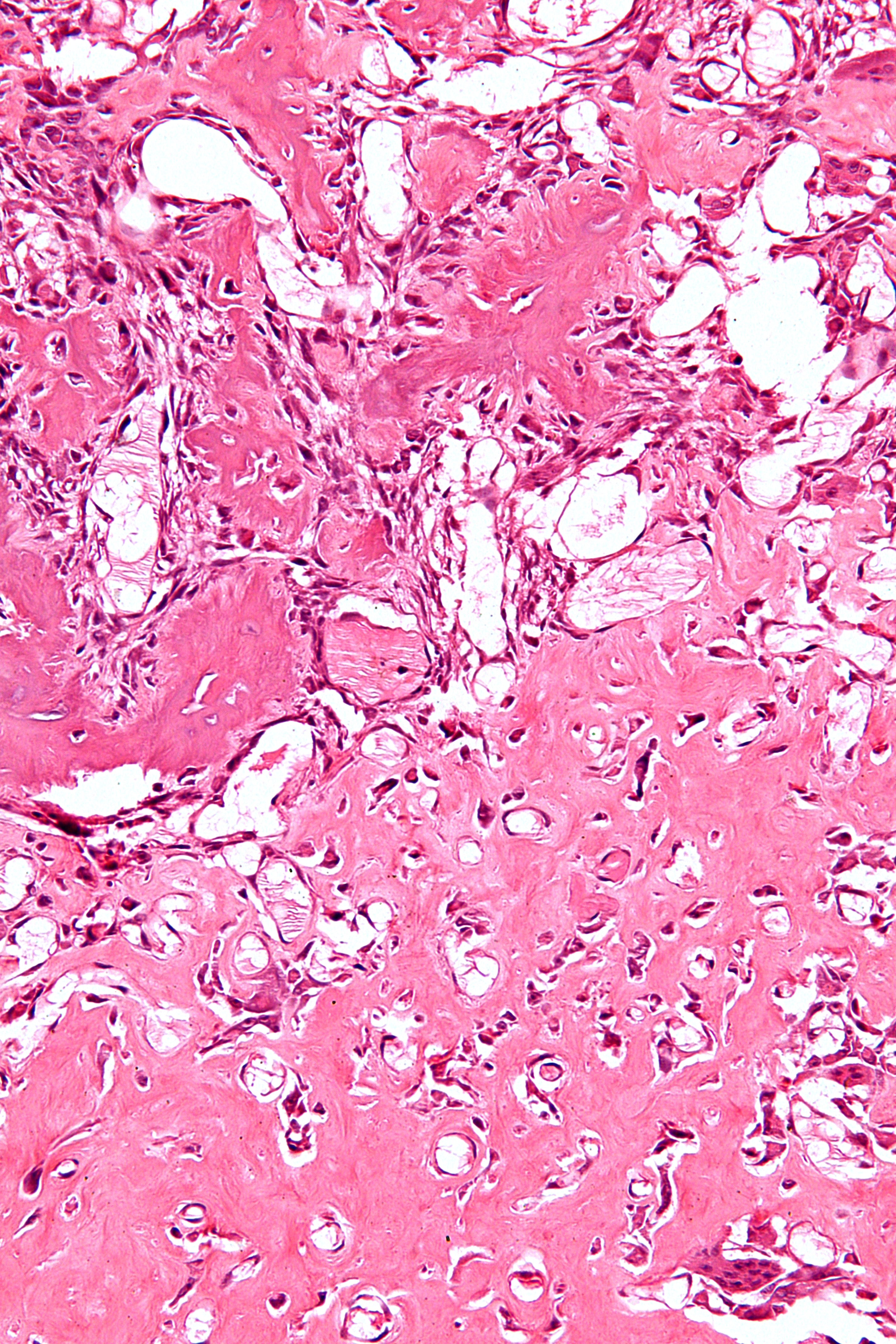 File:Osteoblastoma Histology.jpg