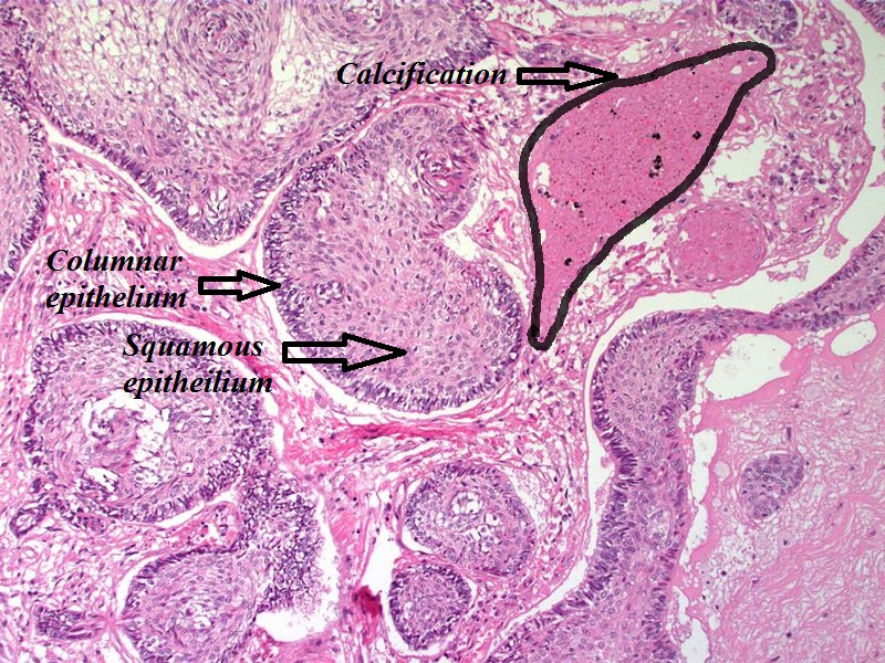 Craniopharyngioma; with calcification and two types of epithelium - by Sarahkayb source: Librepathology