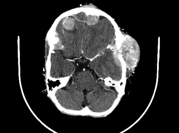 Neuroblastoma observed on CT scan associated with multiple osseous lytic metastases involving the calvaria, skull base, orbit, and mandible with epidural and extra cranial extension[3]