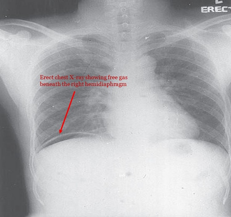 File:Chest X- ray of intestinal perforation.jpg