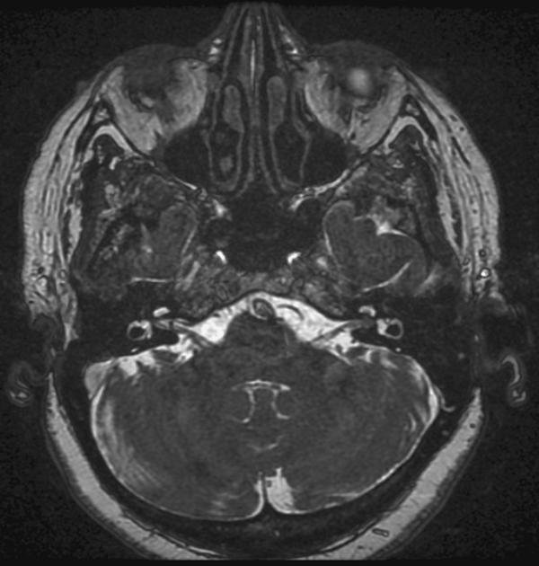File:Intracanalicular acoustic schwannoma.jpg