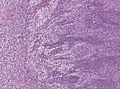 Medullloblastoma demonstrating demsomplastic nodular growth[2]