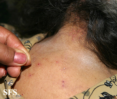 Pediculosis capitis. With permission from Dermatology Atlas.[1]