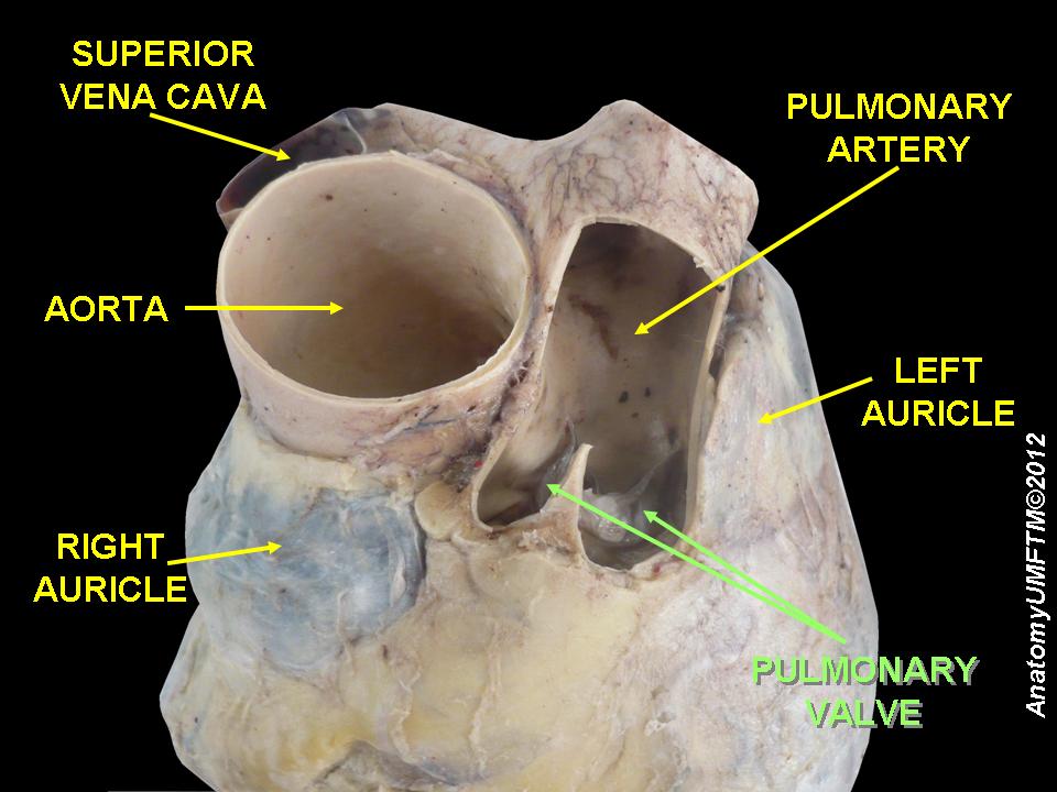File:Pulmonic valve anatomy.jpeg