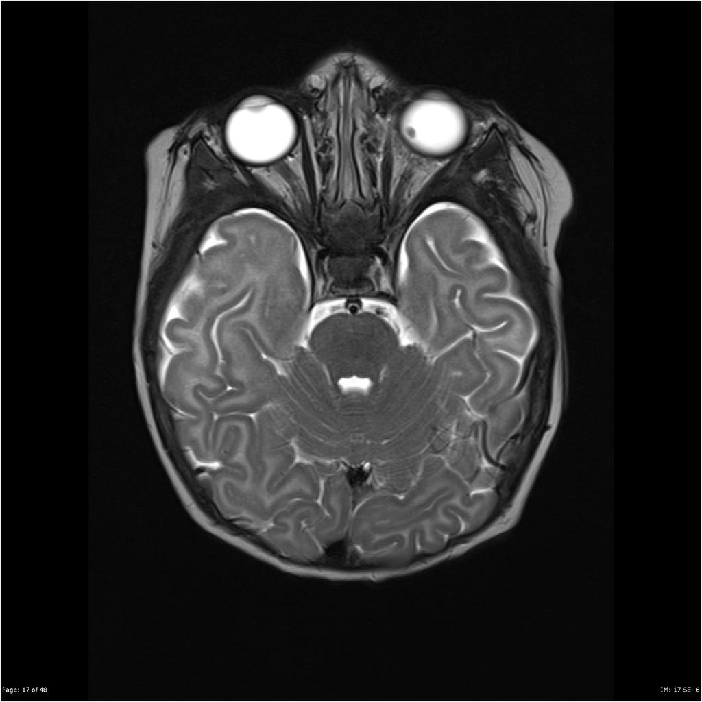 File:Retinoblastoma-5.jpg