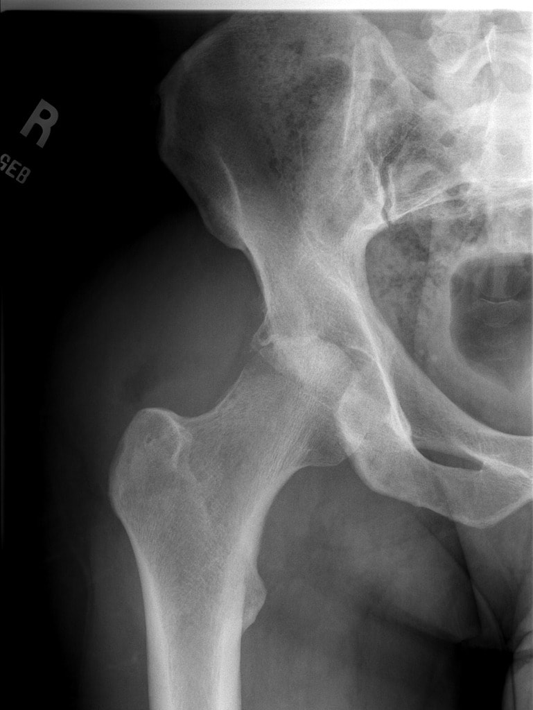 complete loss of the right superior femora acetabular joint space, with mild destruction of the superior aspect of the femoral head and adjacent acetabulum.