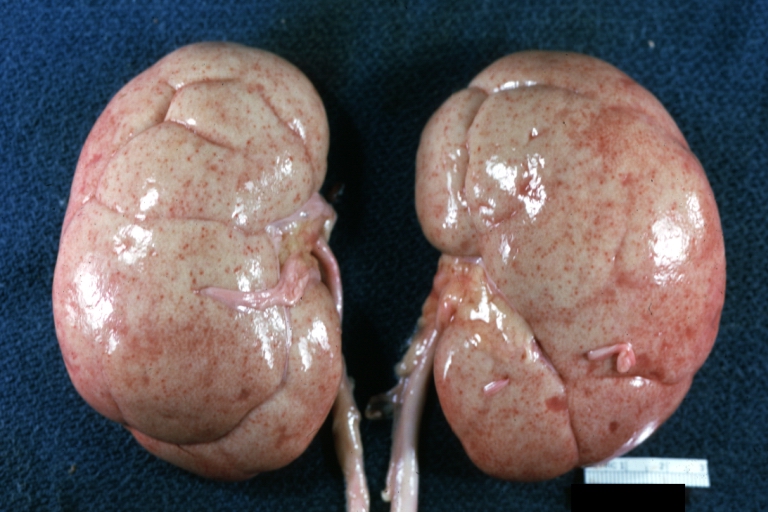 Kidney: Lupus erythematosus: Gross, enlarged very pale kidneys with flea bite or ectasia. A good example of kidneys from a patient with nephrotic syndrome (subacute glomerulonephritis)