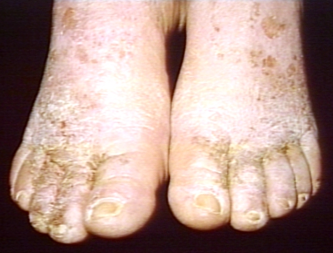Skin: Tinea Pedis, Vesicular; Vesiculobullous Diseases