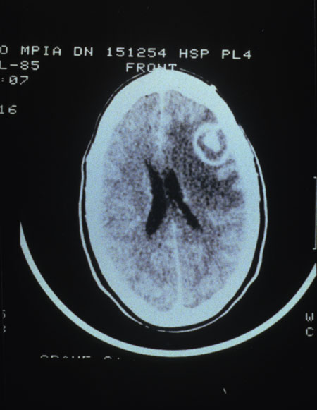 Toxoplasma gondii: CT scan showing cerebral abscess Image obtained from U.S. Department of Veterans Affairs - Image Library [15] (Paul A. Volberding, MD, University of California San Francisco)
