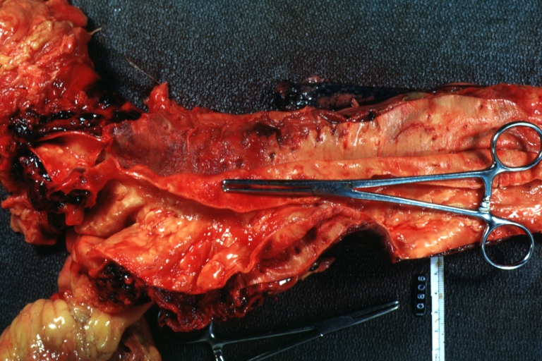 Dissecting Aneurysm: Gross, opened to show false channel (good example)