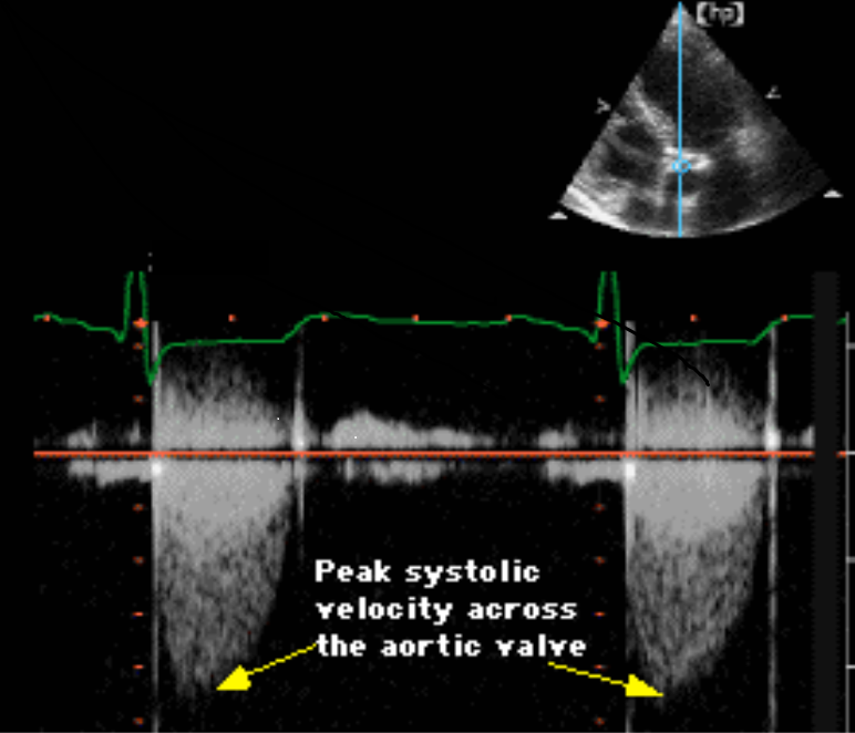 File:Aortic stenosis echocardiography.png