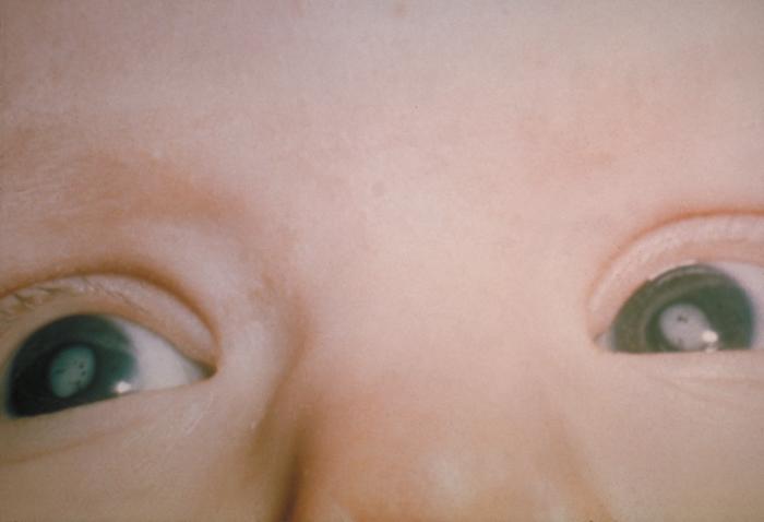 A child with congenital cataracts as a consequence of CRS.