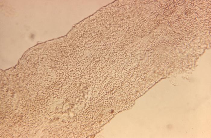 Ultrastructural pathologic changes that were exhibited by a hair shaft affected by an endothrix infection caused by the dermatophytic fungus, Trichophyton tonsurans (200x mag). From Public Health Image Library (PHIL). [1]