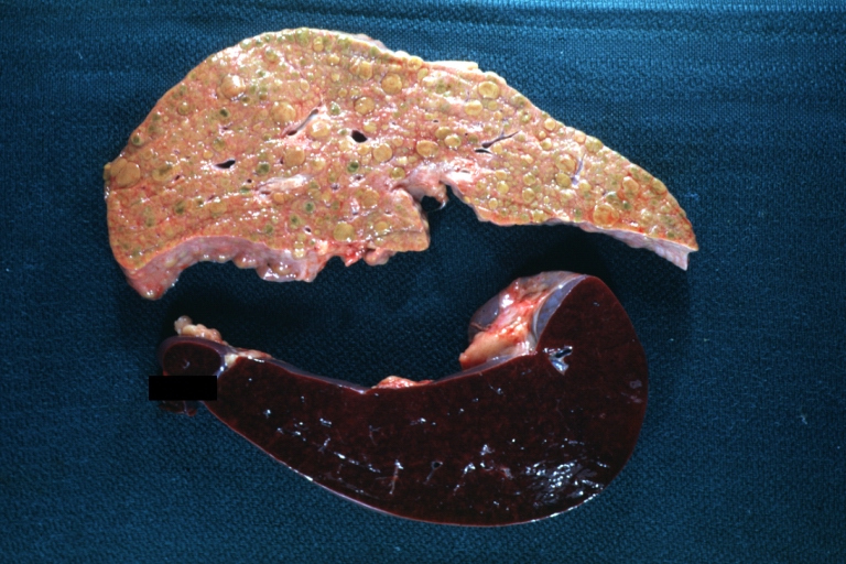 Macronodular cirrhosis: Gross, natural color view of frontal sections of liver and spleen showing a contracted macronodular liver and an enlarged spleen as large as the liver