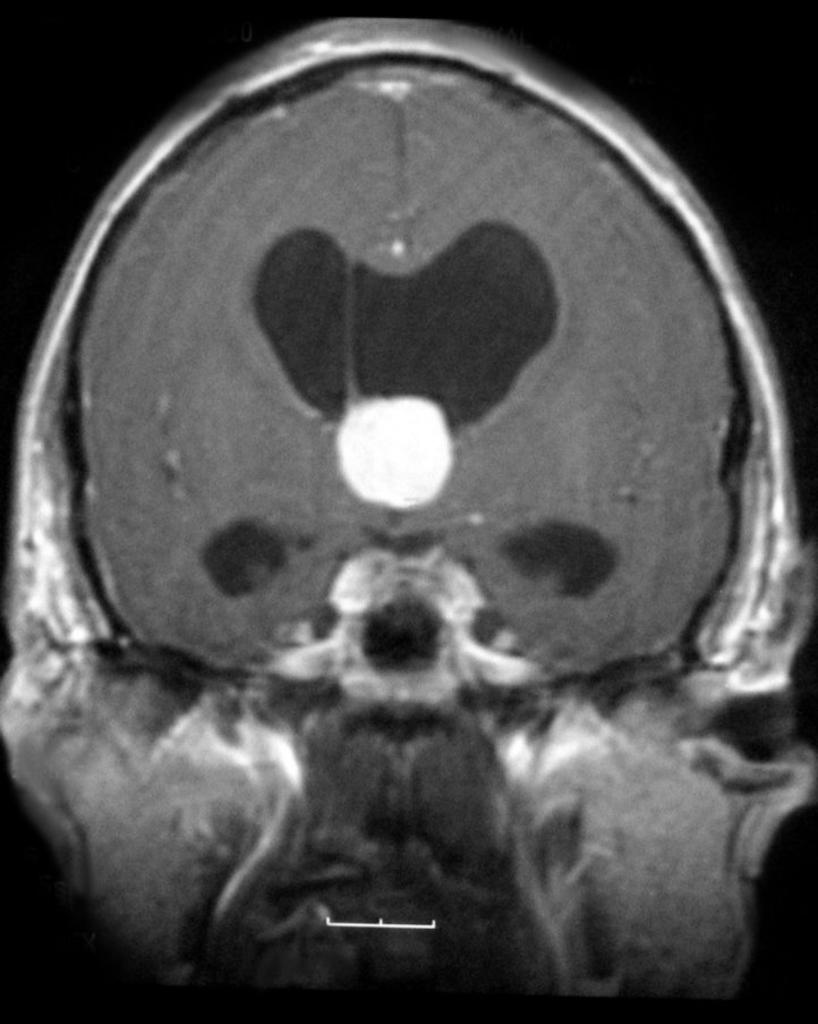 File:Intraventricular-meningioma-third-ventricle-1.jpg