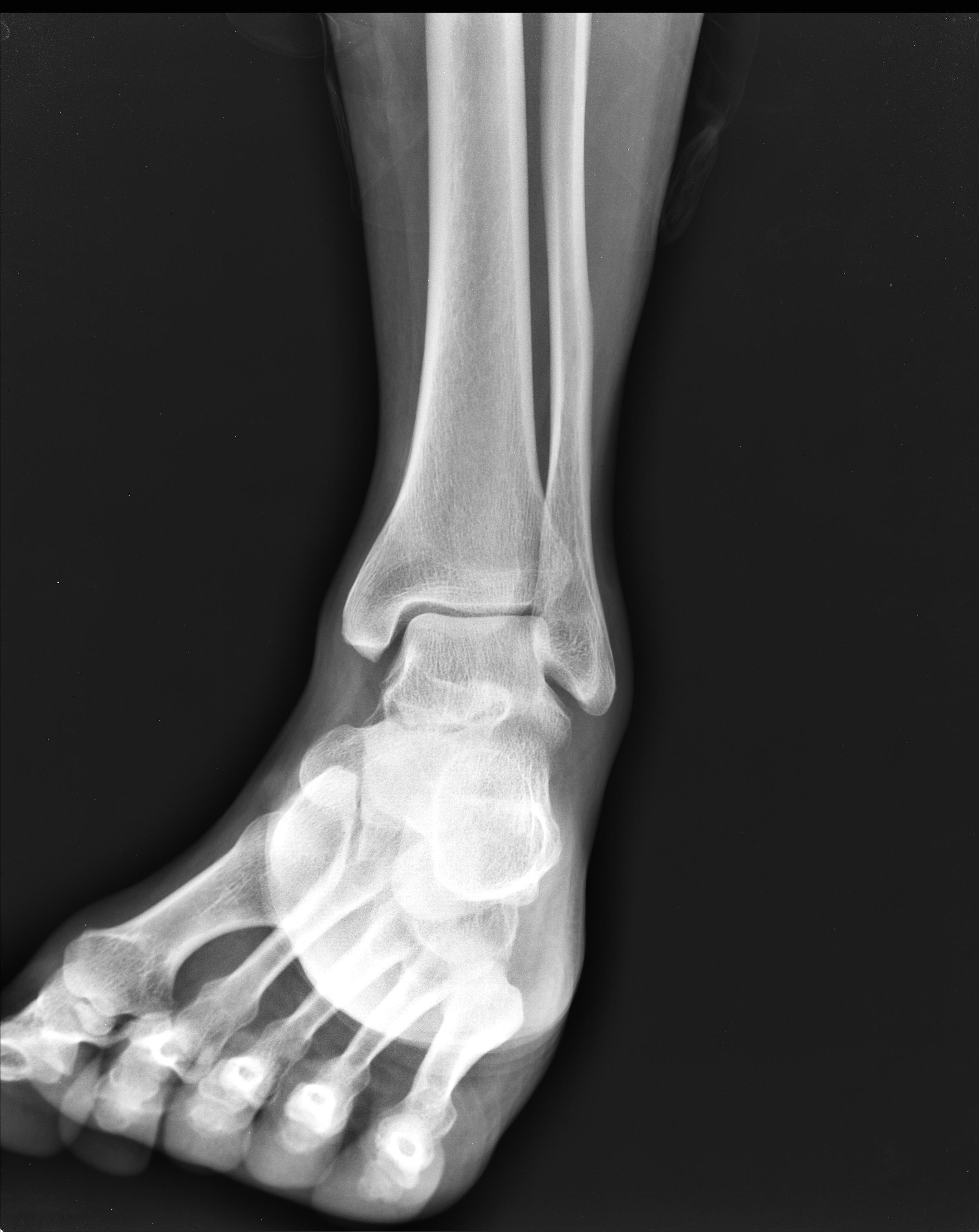 File:Lateral-ankle-ligament-sprain.jpg
