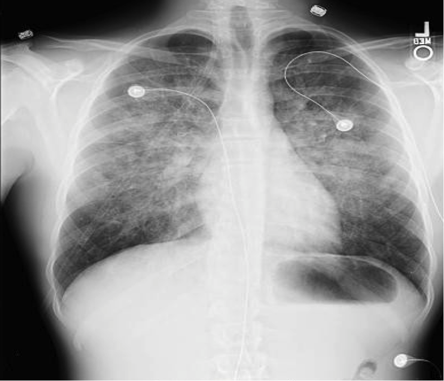 File:Near-drowning noncardiogenic pulmonary edema.png