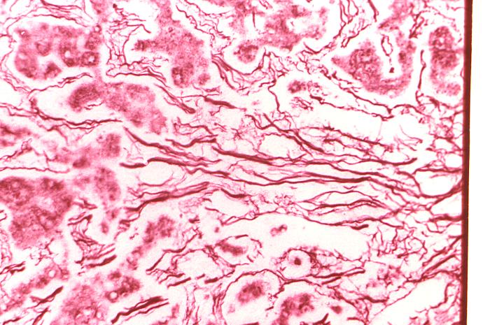 Cytoarchitectural changes found in a liver tissue specimen extracted from a Congo/Crimean hemorrhagic fever patient (400X mag). From Public Health Image Library (PHIL). [4]