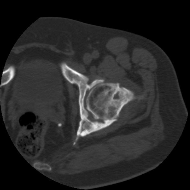 Axial CT scan illustrating full thickness bone destruction of Langerhans cell histiocytosis