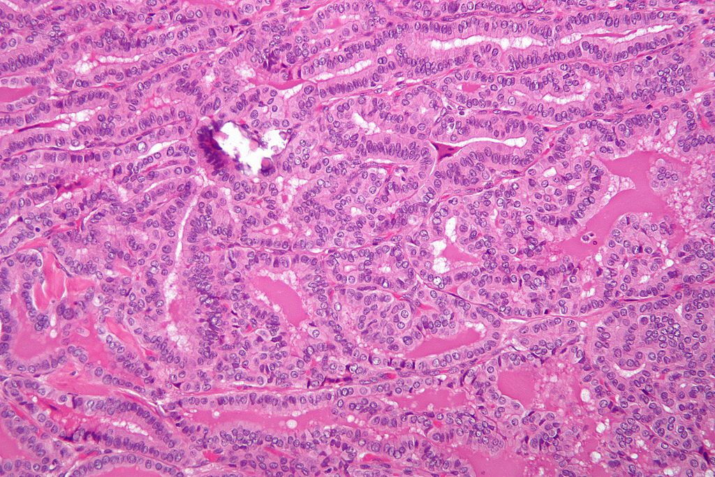 Micrograph of metastatic papillary thyroid carcinoma to a lymph node. H&E stain.[14]