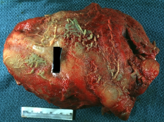 Fibrinous pericarditis: Gross, natural color, an excellent example of bread and butter appearance. Uremia, chronic glomerulonephritis and sepsis.