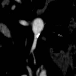 Atherosclerotic plaques seen in the distal aortic arch, aortic bifurcation, and in the external iliac arteries. right renal artery stenosis. 74 year-old male who is status post thromboembolic event of his RLE.