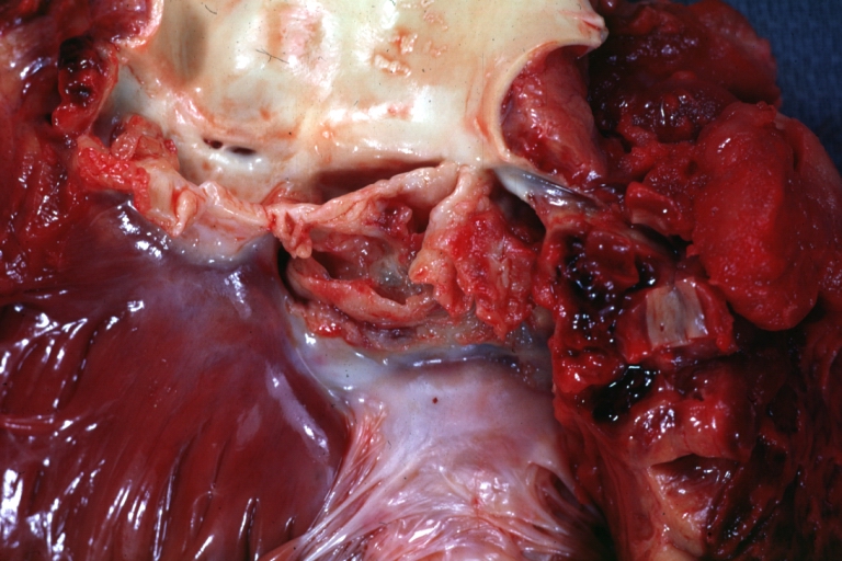 Sinus of Valsalva Aneurysm Infected: Gross; natural color fibrin exudate and some valve scarring are easily seen but aneurysm not seen. The bicuspid valve requires careful look to appreciate Staphylococcus caused lesion.