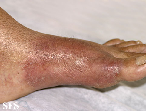 File:Tuberculoid leprosy43.jpg
