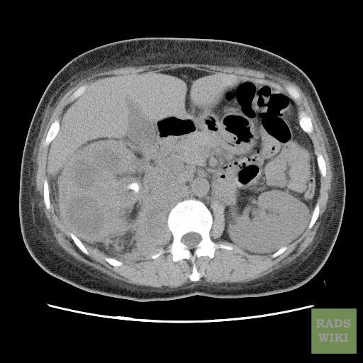 CT image demonstrates right xanthogranulomatous pyelonephritis